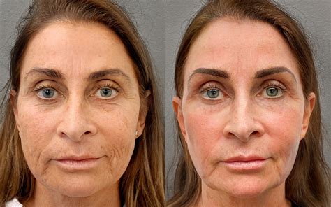 Stemform Outcomes Facial