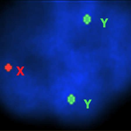 Metaphase Fish Analysis Showing Two Green Signals Of The Centromer Of