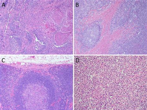 A Lymph Node Metastasis Of Squamous Cell Carcinoma Malignant Cells Download Scientific Diagram