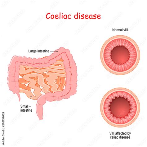 Coeliac Disease Cross Section Of Small Bowel With Normal Villi And Villi Affected By Celiac