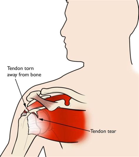 Tendon Tears Shoulder Las Vegas Lake Havasu Bullhead City Mesquite Nevada