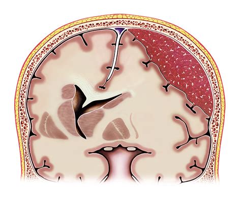 What Are The Different Types Of Brain Injuries Abi Rehabilitation