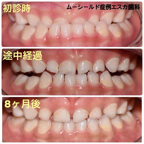 小児反対咬合の治療〜ムーシールド〜について｜esca Blog｜名古屋駅すぐのエスカ歯科・矯正歯科