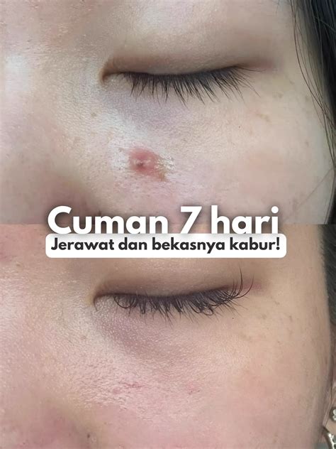 Cuman Hari Jerawat Dan Bekasnya Hempas Galeri Diposting Oleh Nay