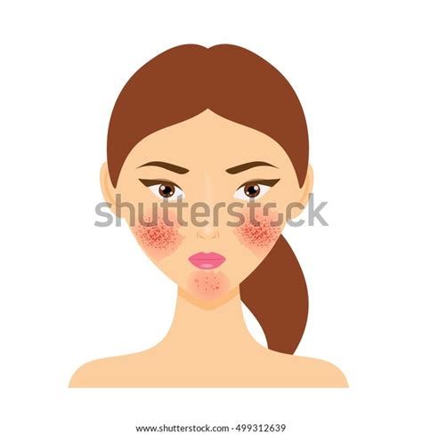 Woman Rosacea Psoriasis Skin Disease Vector Stock Vector Royalty Free