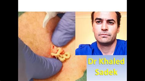 Cheesy Cyst Dr Khaled Sadek Lipomacyst Youtube