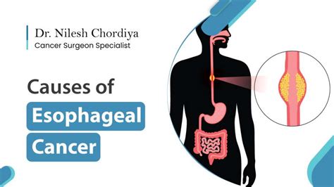 Esophageal Cancer | Symptoms, Causes & Treatment