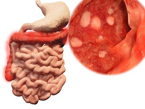 Inflamación intestinal | La Prensa Panamá