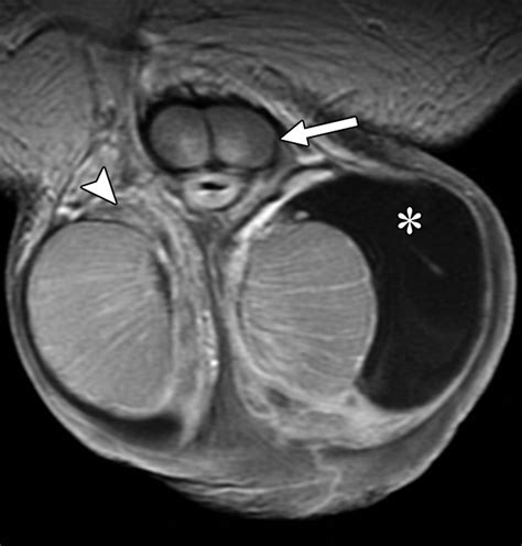 Mr Imaging Of Scrotal Tumors And Pseudotumors Radiographics