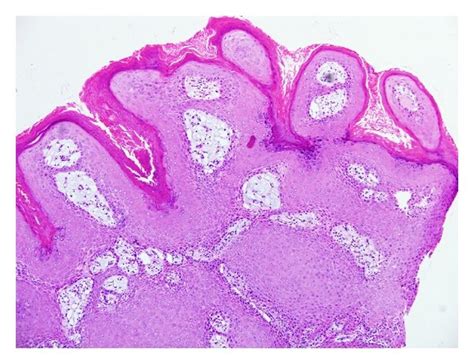 Verrucous Hyperplasia Low Power Magnification View Showing Epidermal