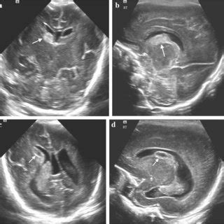 A Posterior Subependymal Grade I Germinal Matrix Hemorrhage In A