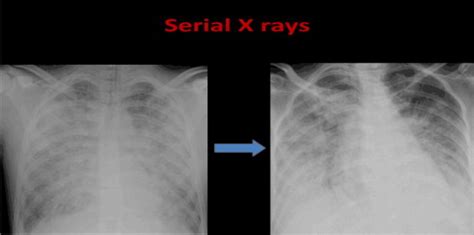 Ards Chest X Ray