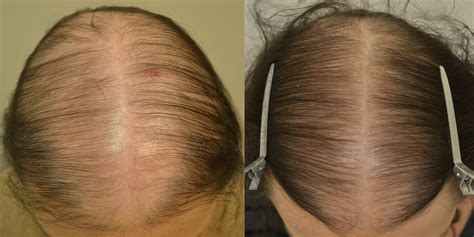 Finasteride Spironolactone And Minoxidil Females Before And After Photos Hair Restoration Of