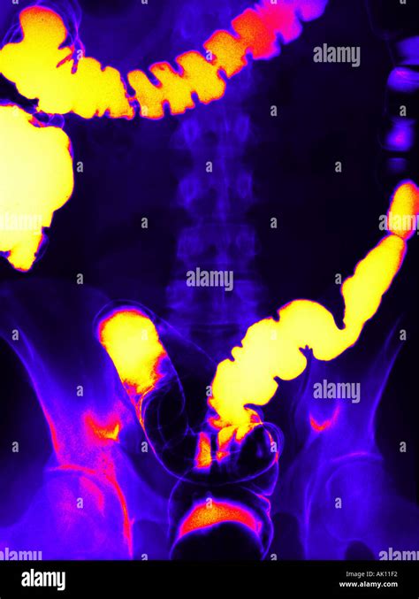 Barium Enema X Ray Digitally Coloured Hi Res Stock Photography And