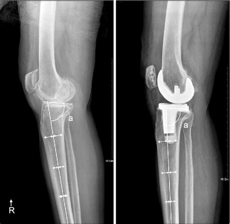 Figure 1 From The Change Of The Posterior Tibial Slope After Cruciate