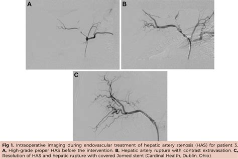 Figure 1 From Complications After Endovascular Treatment Of Hepatic Artery Stenosis After Liver