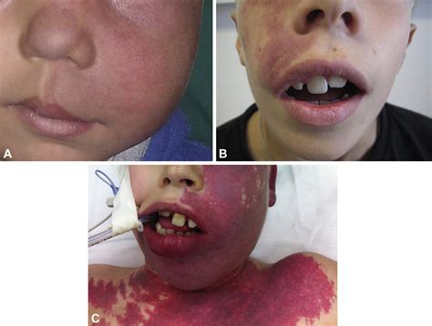 Prognosis And Response To Laser Treatment Of Early Onset Hypertrophic Port Wine Stains Pws