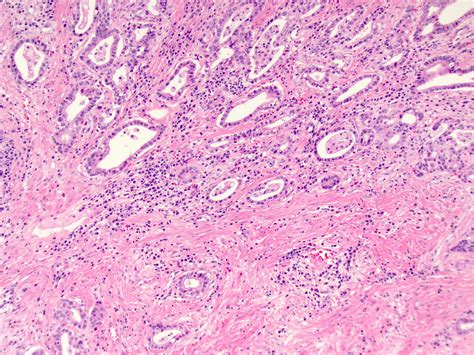 Pathology Outlines Adenocarcinoma Of The Esophagus And Ge Junction