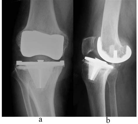 Aseptic Loosening Case A Anteroposterior View B Lateral View Download Scientific Diagram