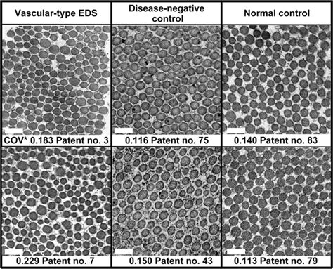 Frontiers Clinical Features And Morphology Of Collagen Fibrils In