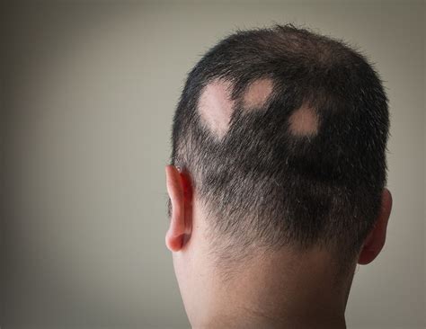 Alopecia Still In The Spotlight