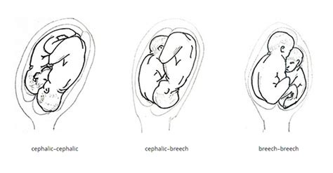 Uterus Growth In Twin Pregnancies