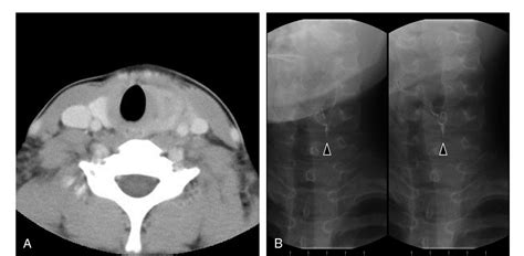 Figure 1 From Preoperative Identification Of The Internal Opening With The Modified Killian S