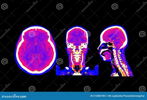 Collection Colorful Of CT Angiography Of The Brain Or CTA Brain