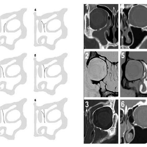 (Left) A coronal CT scan illustrating the agger nasi cell (*) and ...