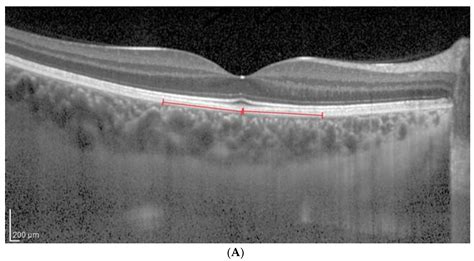 Jcm Free Full Text Impact Of Brightness On Choroidal Vascularity Index