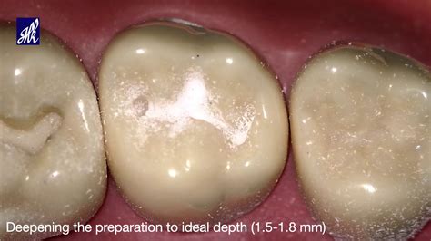 Class I Cavity Preparation For Amalgam Mandibular Molar Off