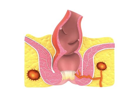 Comment Reconnaître un Abcès Anal Avrupa Cerrahi Tıp Merkezi