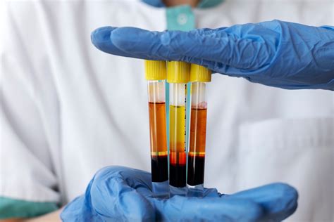 Platelet Rich Plasma PRP Therapy In Cincinnati Renew Medical Centers