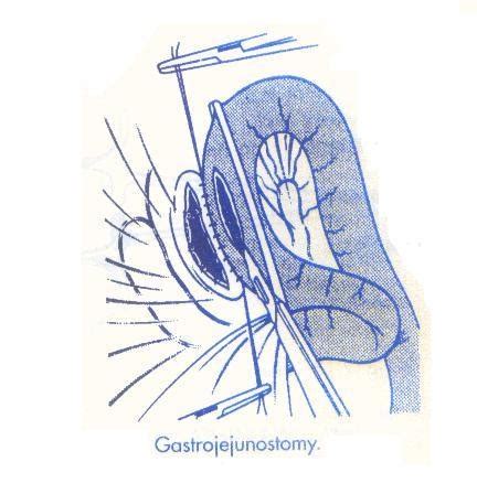 OTMANAGE: GASTRO JEJUNOSTOMY PROCEDURE 2