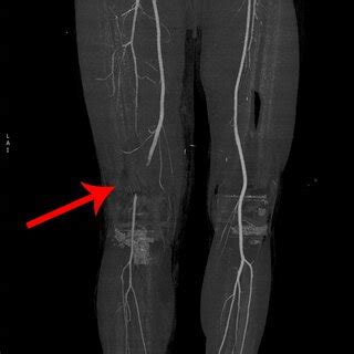 typical case  diagnosed  traumatic blunt popliteal artery