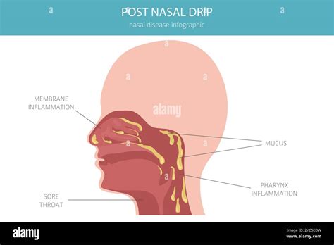 Post Nasal Drip Nasal Diseases Medical Infographic Design Vector