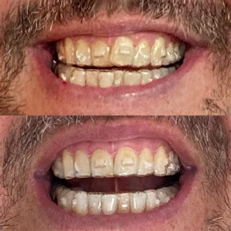 Before And After Pics Of Overjet Correction R Invisalign