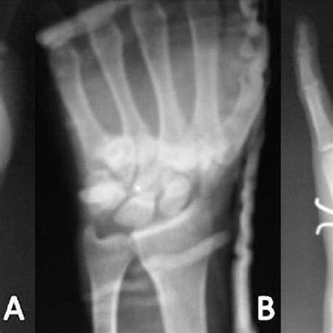 A Initial X Rays Showing Dorsal Dislocation Of Ulnar Four Metacarpal