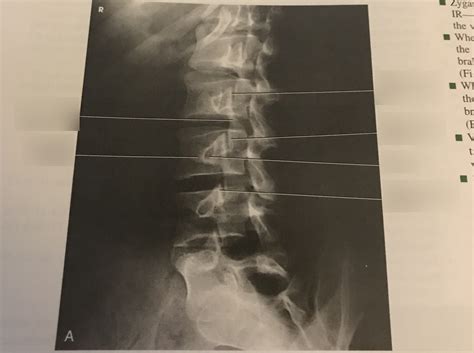 L Spine Oblique Diagram Quizlet