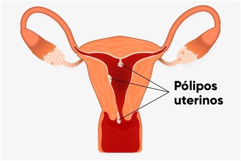 Como identificar pólipos uterinos e quando são perigosos Tua Saúde