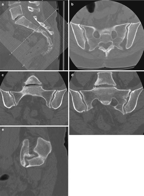 Spondyloarthropathy | Radiology Key