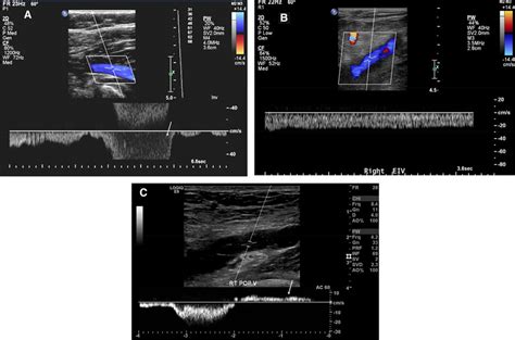 Duplex Ultrasound In The Diagnosis Of Lower Extremity Deep Venous