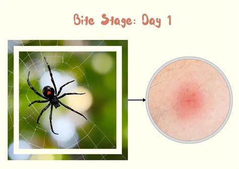 Southern Black Widow Spider Bite: Stages, Symptoms with Pictures ...