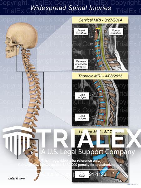 Widespread Spinal Injuries Trial Exhibits Inc