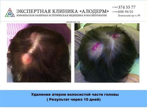 Как Выглядит Атерома На Голове Фото — Картинки фотографии