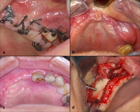 A Suture Dehiscence 1b Infection 1c Mucosal Perforation And 1d