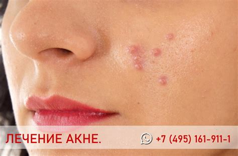 Гнойники на голове в волосах: причины, лечение | Capillum Clinic