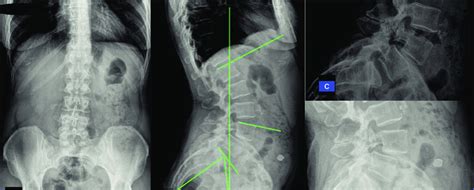 A B Antero Posterior And Lateral Lumbar Standing Radiographs And C