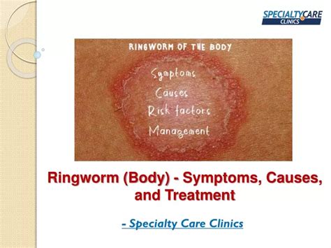 Ppt Ringworm Body Symptoms Causes And Treatment Powerpoint