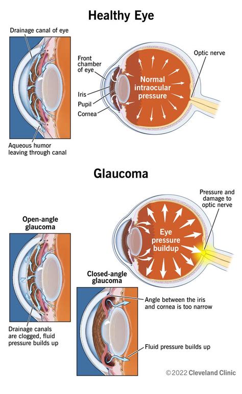 Glaucoma And Surgery Is It The Right Step For You Eye Surgery Guide